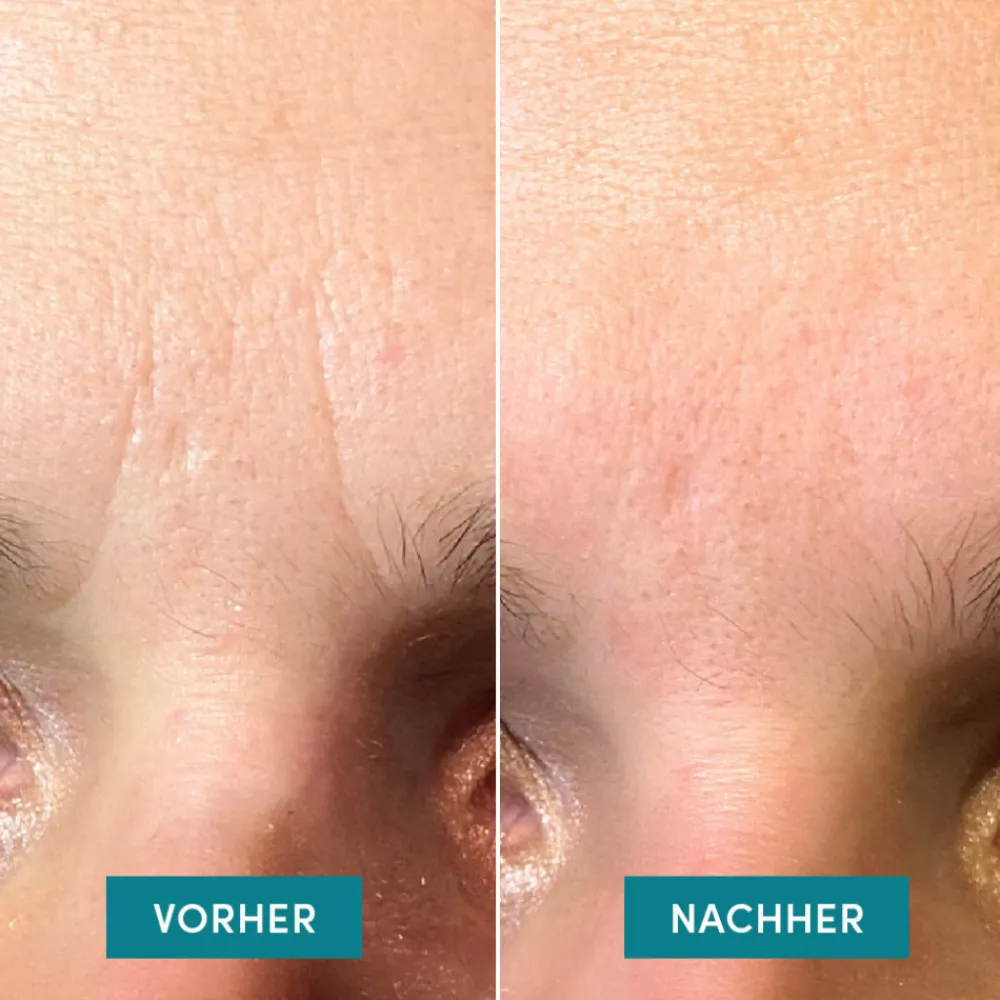 APRICOT Hagel Nature|Hautverjüngung^Gesicht Patches mit Ectoin