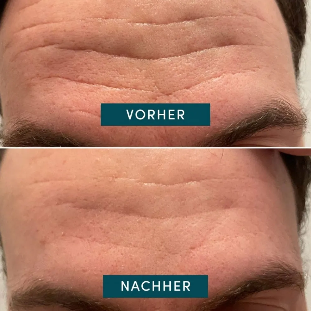 APRICOT Hautverjüngung|Gesicht^Mini Gesicht Patches mit Niacinamide 24 Stück