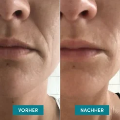 APRICOT Hagel Nature|Hautverjüngung^Mund Patches mit Niacinamide