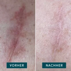 APRICOT Gesicht|Körper|Scar Pads Mini 4 Stück