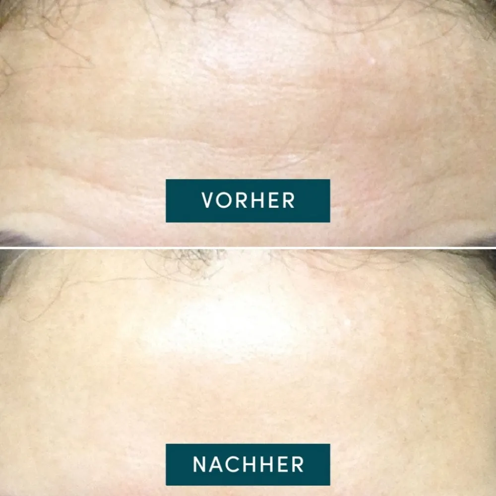 Wiederverwendbares Stirn Pad mit Hexapeptid-Technologie-APRICOT Clearance