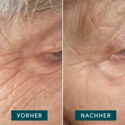 APRICOT Hautverjüngung|Gesicht^Wiederverwendbare Augen-Schläfen Pads mit Hyaluron