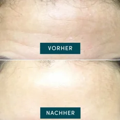 APRICOT Gesicht^Wiederverwendbares Stirn Pad mit Hyaluron