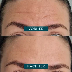 APRICOT Gesicht^Wiederverwendbares Stirn-Pad mit Ectoin