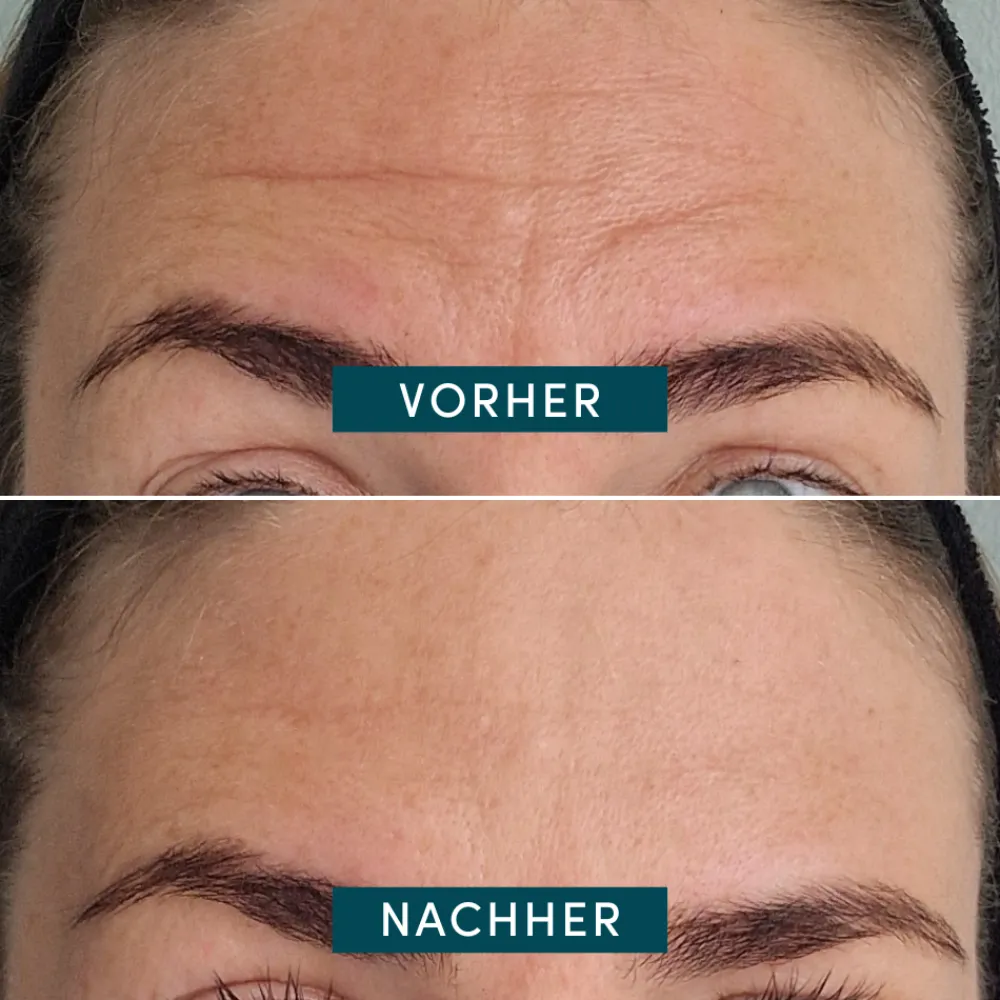 APRICOT Gesicht^Wiederverwendbares Stirn-Pad mit Ectoin