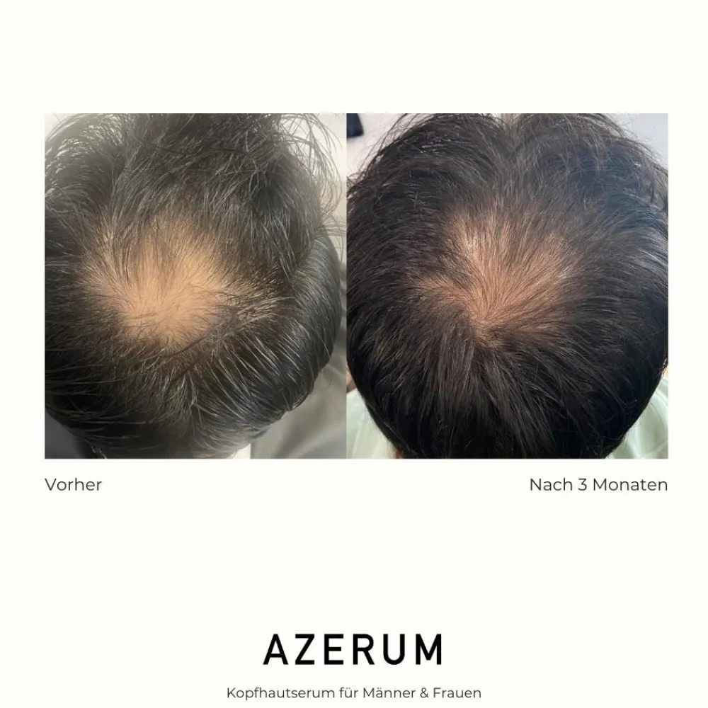 AZERUM Haarausfall|Haarverdichtung^Kopfhautserum 100 ml