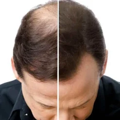 Natucain Haarausfall|Haarausfall & Spezialpflege^Hair Activator 100 ml