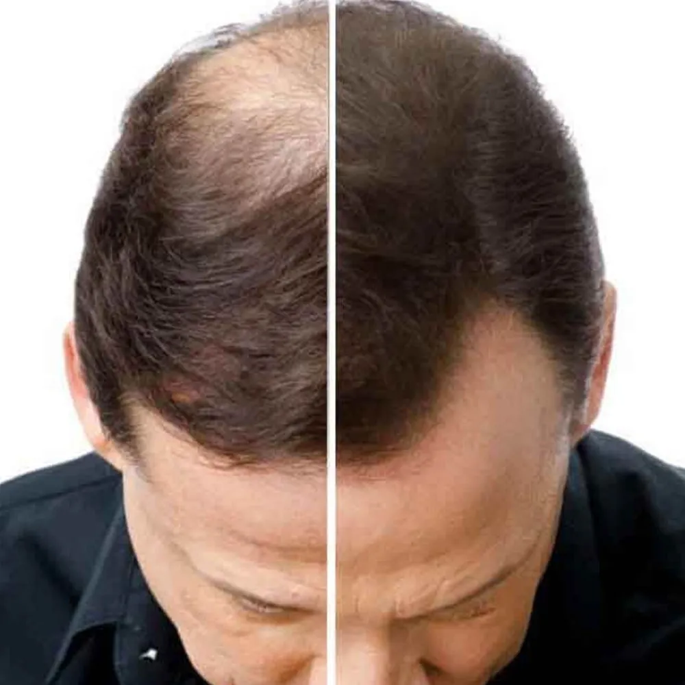 Natucain Haarausfall|Haarausfall & Spezialpflege^Hair Activator 100 ml